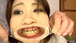 ♦️【歯フェチ #21】♦️4K新口腔内観察 ⭐️ リンカちゃん 💖 虫歯満載、抜歯も必要、大放出